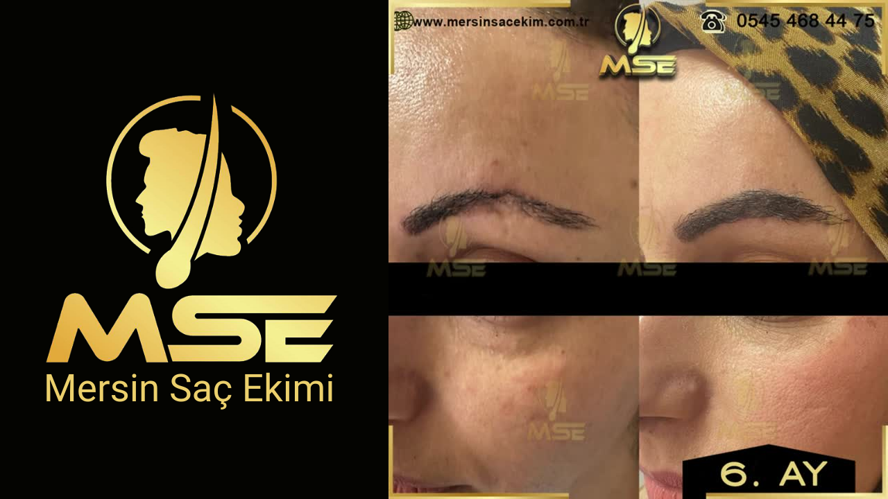 Mersin Saç Ekimi